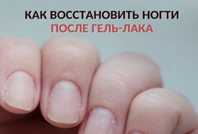 Болят ногти после покрытия гель лаком Болят ногти после покрытия гель лаком