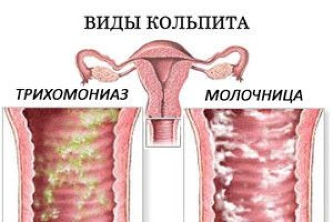 Основная причина гинекологических заболеваний у женщин