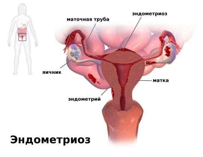 Основная причина гинекологических заболеваний у женщин