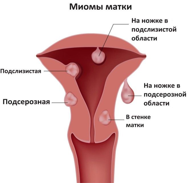 Основная причина гинекологических заболеваний у женщин