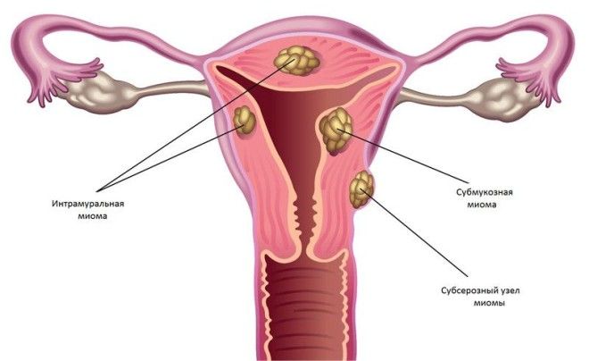миома матки