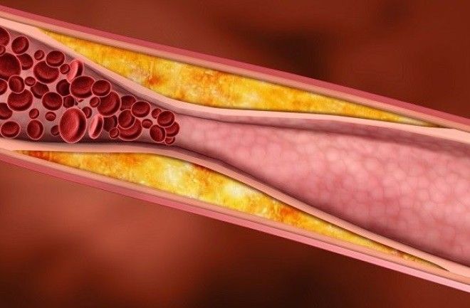 Одна из главных причин атеросклероза
