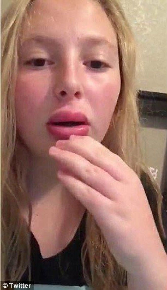 губы как у Кайли Дженнерkyliejennerchallenge экстремальное увеличение губ засовывают губы в маленькие баночки увеличение губ отек