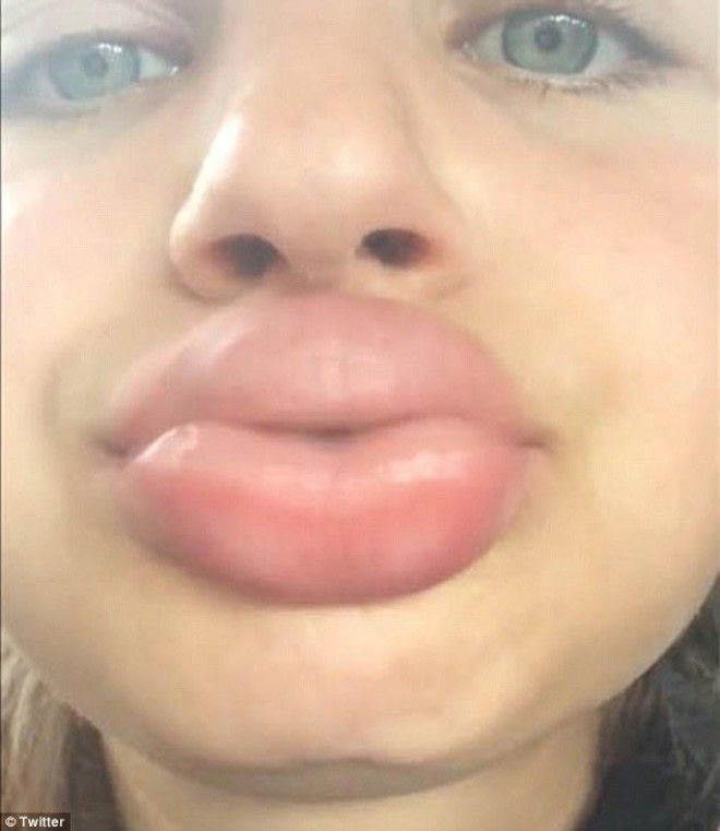 губы как у Кайли Дженнерkyliejennerchallenge экстремальное увеличение губ засовывают губы в маленькие баночки увеличение губ отек