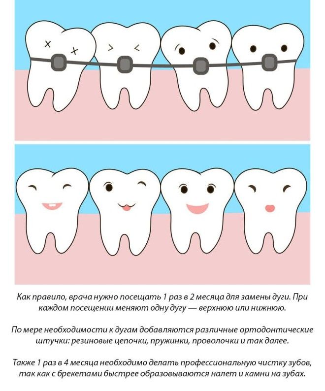 11 фактов о брекетах, которые нужно знать перед их установкой