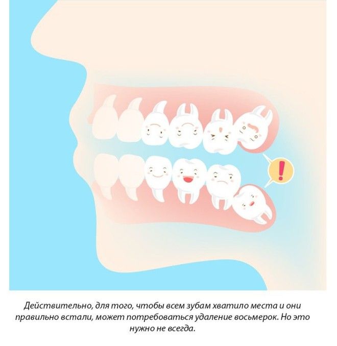 11 фактов о брекетах, которые нужно знать перед их установкой