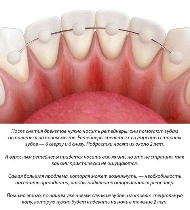 11 фактов о брекетах, которые нужно знать перед их установкой