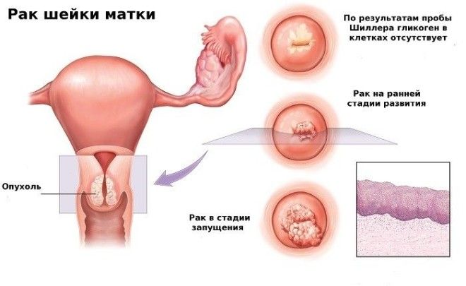 папилломавирус шейки матки