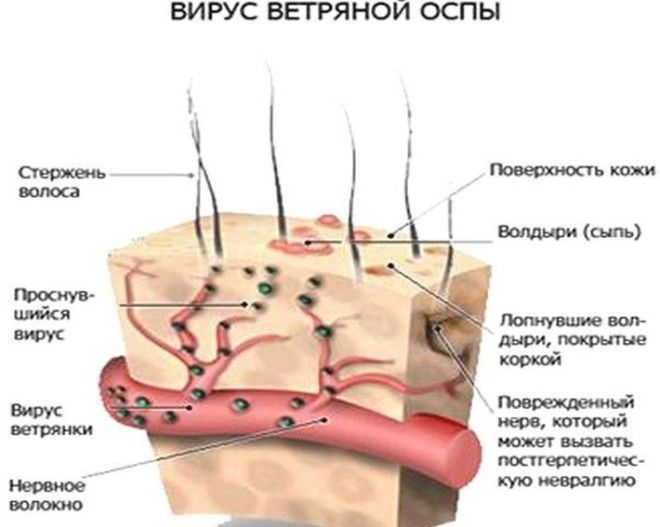 Ветрянка детские болезни здоровые опасно для взрослых факты