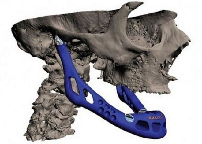 Вчерашняя фантастика: 3-D принтер создает челюсти для трансплантации.