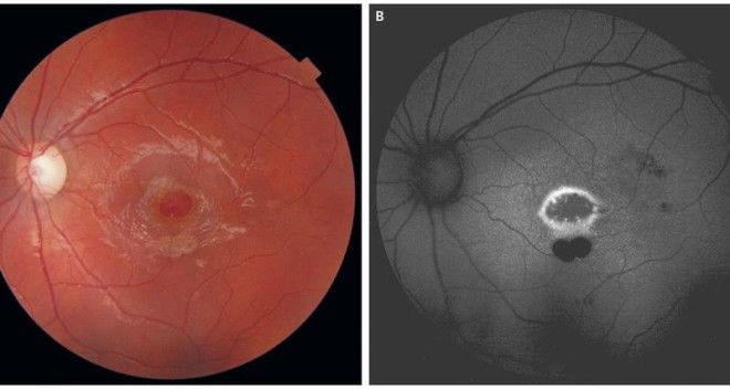 Почему не&nbsp;стоит светить лазерной указкой в&nbsp;глаз