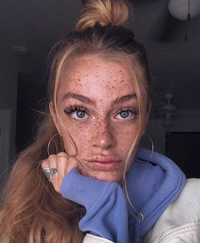 Немецкая модель хвастается огромным количеством веснушек