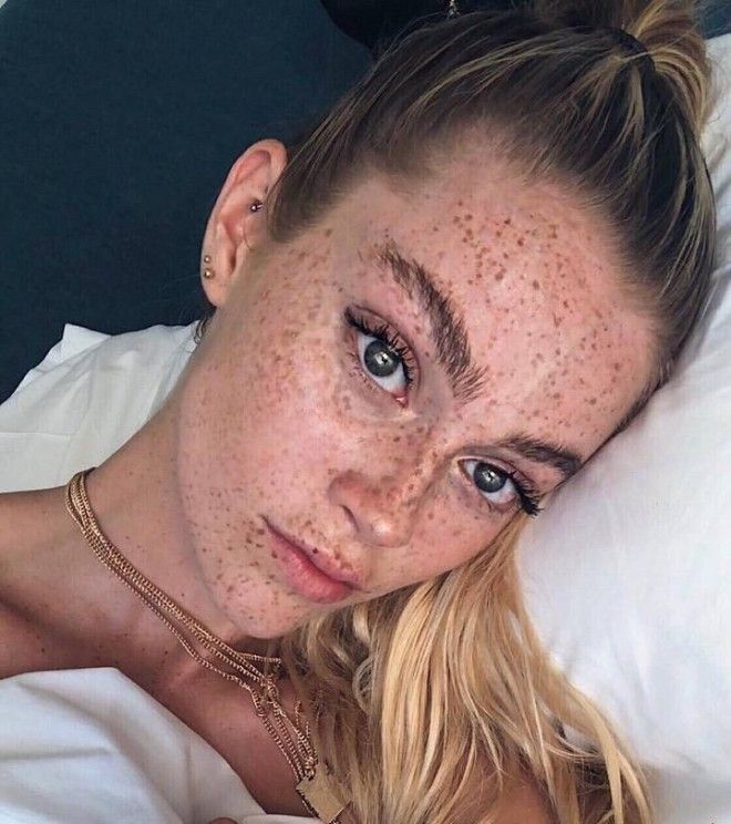 Немецкая модель хвастается огромным количеством веснушек