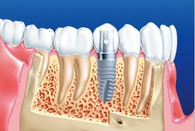 Многие люди считают имплантацию безопасным и надежным методом...