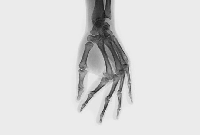 Заработают ли артрит те, кто вечно разминают пальцы и суставы